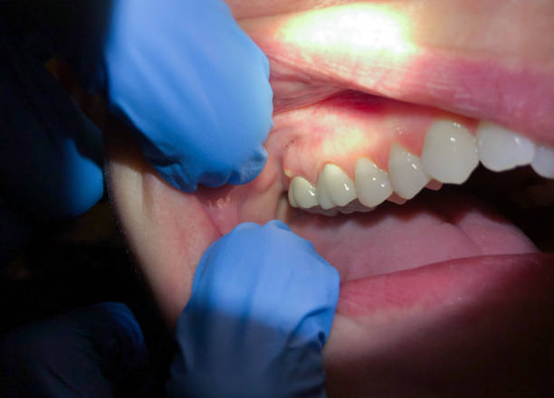 Best Emergency Dental Care for Broken or Chipped Teeth in Arnold, PA